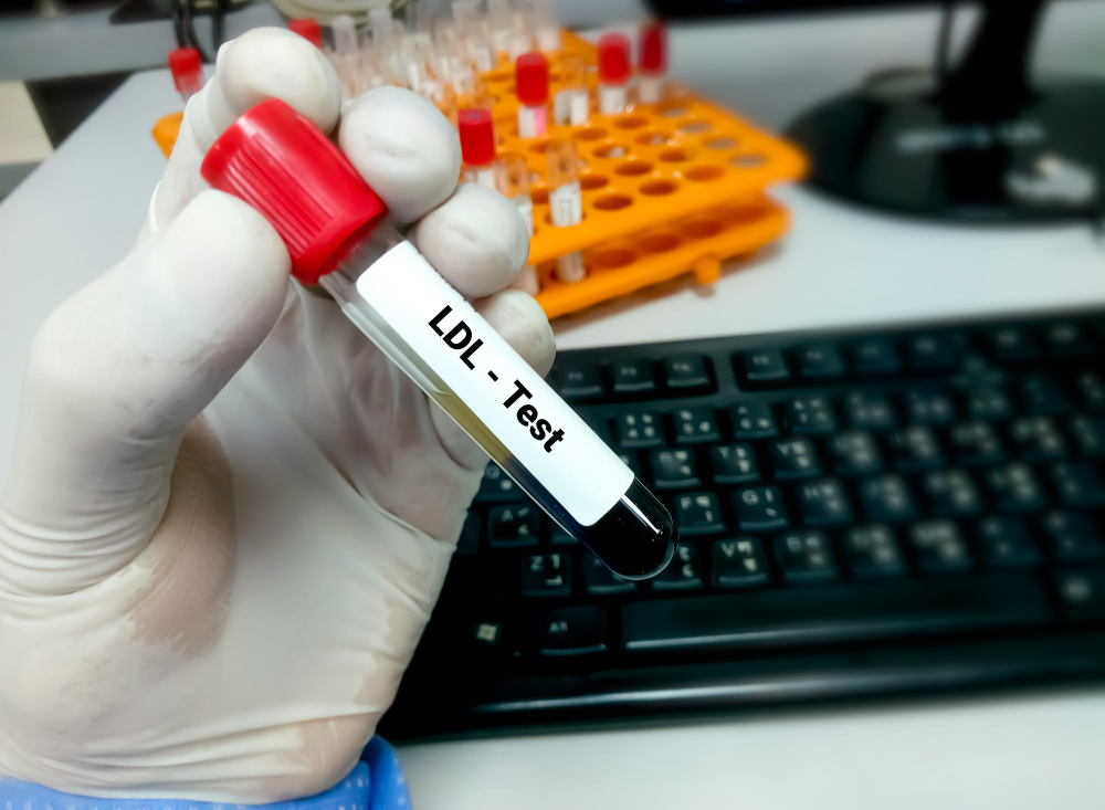 Próbka krwi do testu ldl lub lipoprotein o niskiej gęstości