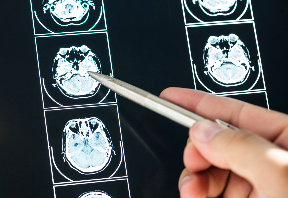 Zbliżenie wyniku skanowania MRI mózgu